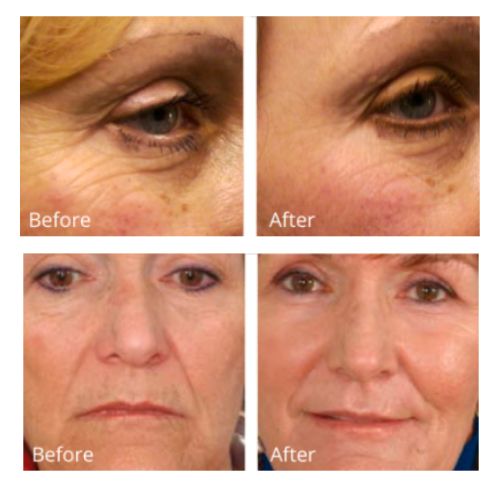 FaceLite Led Gezichtsmasker - Afbeelding 5